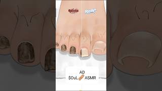 ASMR Ingrown Toenail Removal Treatment AnimationStrong Satisfaction mengstopmotion [upl. by Akselaw]