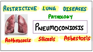 Restrictive Lung Diseases PNEUMOCONIOSIS Anthracosis  Silicosis  Asbestosis pathology robbins [upl. by Retsehc999]