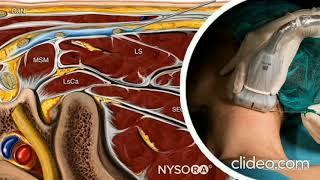 ULTRASOUND GUIDED CERVICAL PLEXUS BLOCK FOR CLAVICLE SURGERY [upl. by Jackie]