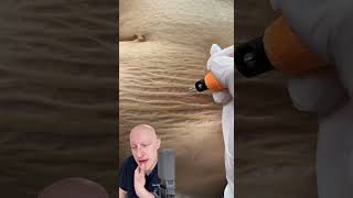 Plasma Pen As A Cure For Stretchmarks  Doctor Reacts [upl. by Natek]