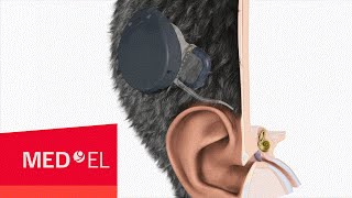 The RONDO cochlear implant from MEDEL  2D  INT [upl. by Kenta]