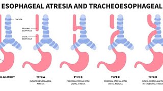 TRACHEOESOPHAGEAL 🫁FISTULA TEFESOPHAGEAL ATRESIA👍🏻HINDI msnpediatrics tracheoesophagealfistula [upl. by Shiri]