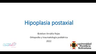 Hipoplasia Postaxial [upl. by Ellevel988]