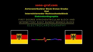 Elektrokardiographie  Atrioventrikulärer Block Ersten Grades Intermittierender Rechtsschenkelblock [upl. by Hpotsirhc]