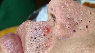 Big Cystic Acne Blackheads Extraction Blackheads amp Milia Whiteheads Removal Pimple Popping  313 [upl. by Adiazteb469]