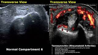 Wrist Hand amp Finger Ultrasound Normal Vs Abnormal Images  Tenosynovitis Rheumatoid Arthritis USG [upl. by Bela]