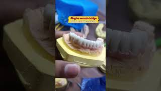 GingivaceramicbridgedentistmumbaiindianspleasesubscribememeDentalteethtechnician [upl. by Gadmann988]