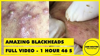 Full Video 1hour 46s AMAZING INFLAMED BLACKHEADS POPPING [upl. by Nirrol]