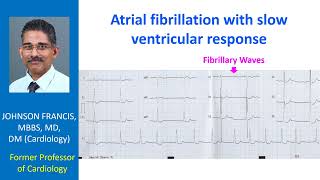 Atrial fibrillation with slow ventricular response [upl. by Yrekaz]