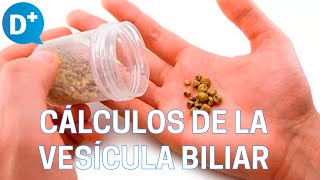 Causas y síntomas de los cálculos de la vesícula biliar [upl. by Korwun]