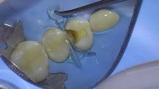 CLASS 2 COMPOSITE RESTORATIONS PERFROMED WITH RUBBER DAM [upl. by Bat]