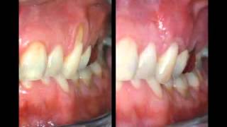 Treatment for Receding Gums [upl. by Falcone]