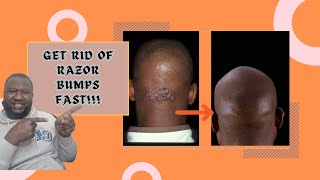 How to Get Rid of Your Razor Bumps [upl. by Suinuj]