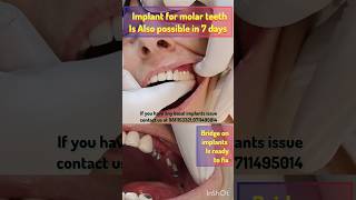 Now molar basal Implants are possibleget teeth in just 5 days basalimplants [upl. by Paschasia]