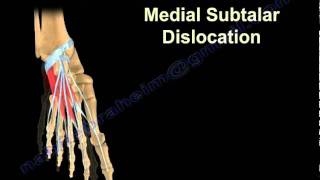 Dislocations Of The Talus  Everything You Need To Know  Dr Nabil Ebraheim [upl. by Butterworth]