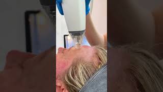 Potenza RF Microneedling and Exosomes [upl. by Eihpos524]