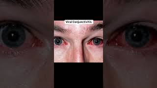 Know about conjunctiva disease 🩺✨💉🥀 love optometrist doctor optometry music mbbs doctor [upl. by Eiramlatsyrc741]