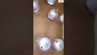 asmr massage wet cup cupping manual therapy hijama chiropractic الحجامة الحجامةالنبوية [upl. by Marya115]