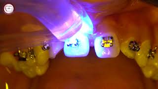 Braces bonding step by step in orthodontics amp wire insertion [upl. by Dyanna311]