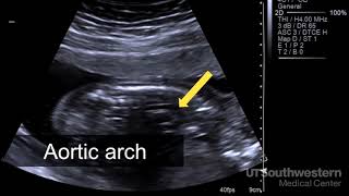 Understanding your fetal ultrasound [upl. by Ilahsiav]