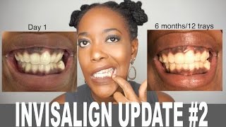 6 MONTH INVISALIGN UPDATE WITH PICTURES [upl. by Nace468]