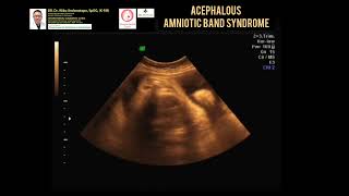 Acephalous  Amniotic band syndrom [upl. by Kcireddor]