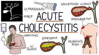 Understanding Acute Cholecystitis [upl. by Enelrak954]