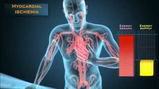 Understanding the energetic mechanisms that cause angina pectoris [upl. by Idoc]