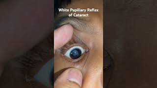 Leukocoria  White Pupillary Reflex of cataract [upl. by Nnylyak]