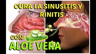 CÓMO CURAR LA SINUSITIS Y RINITIS ALÉRGICA CON ALOE VERA  LifeStyle [upl. by Volpe]