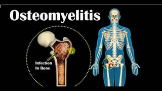 ORTHOPEDICS LECTURES  OSTEOMYELITIS Part 1 [upl. by Albert]