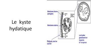 PNEUMOLOGIE KYSTE HYDATIQUE 2016 [upl. by Jaye]