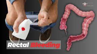 When to Be Worried About Rectal Bleeding [upl. by Allerim]