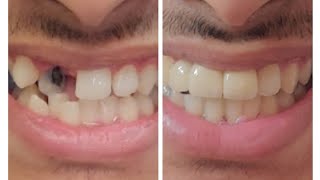 Multidisciplinary treatment with braces endodontics and prosthodontics [upl. by Nolla182]