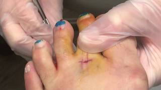 Extensor Hammertoe Surgery [upl. by Meuser]