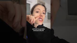 Dentist Reveals How To Fix Your GUMMY Smile 😁🦷 [upl. by Norha]