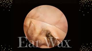 Massive ear wax [upl. by Aihsekan]