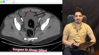 CT SCAN Axial View Pelvis showing Free Fluid In Pelvis FCPS PART 2 CPSP MS MD [upl. by Corrie]