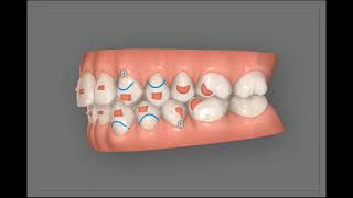 Invisalign clincheck Treatment simulation to corect an open bite for adult patient [upl. by Liane]