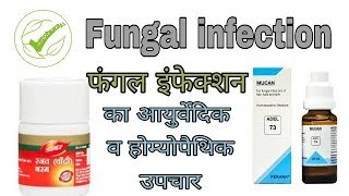 Fungal infection quotफंगल इंफेक्शनquot की प्रॉब्लम कि आयुर्वेदिक व होम्योपैथिक मेडिसिन । [upl. by Wycoff733]