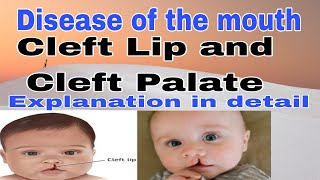 Cleft lip and cleft palate [upl. by Noli]