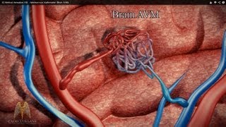 3D Medical Animation HD  Arteriovenous Malformation Brain AVM [upl. by Enamart239]