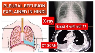 Pleural Effusion  फेफड़ों में क्यों भर जाता है पानी   Pleural Effusion CT Scan Lungs Explained [upl. by Fleischer]