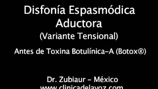 Disfonía Espasmódica Variante Tensional pre y post Botox® [upl. by Ydisac35]