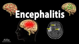 Encephalitis Animation [upl. by Solberg341]