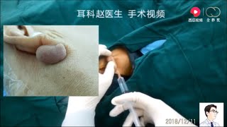 Treatment of earlobe scar keloid [upl. by Seumas683]