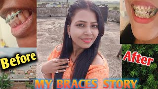 My Braces Journey 😊 Braces Before and after  ND Family Vlogs [upl. by Burrow]