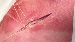 Deep Dermal Sutures [upl. by Irmine]