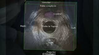 OnabotulinumtoxinA Injection of the Levator Ani Muscles under Ultrasound Guidance [upl. by Margarida]