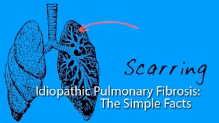 Idiopathic Pulmonary Fibrosis The Simple Facts [upl. by Brocklin]